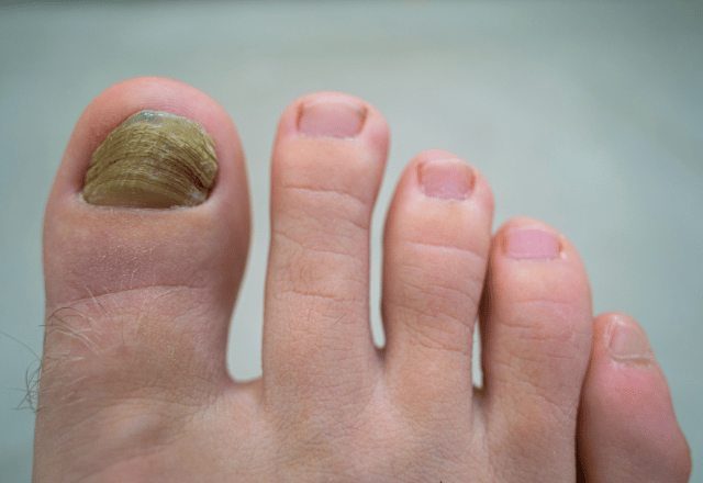 Nagelsvamp Bilder - Exempel på nagelsvamp