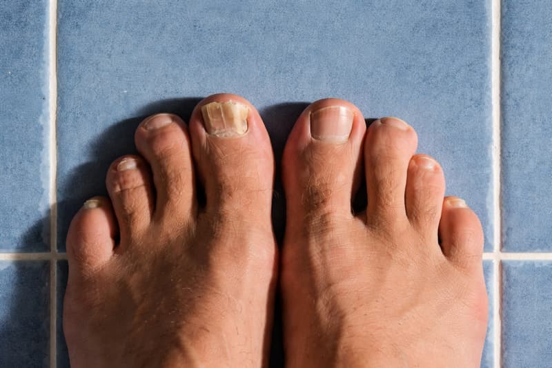 Bilder av neglesopp – Slik ser neglesopp ut
