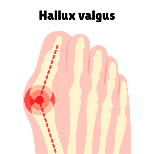 Toe Spreader - 2 stykker - Beskyttelse for hallux valgus, stor (skostørrelse 40-45)